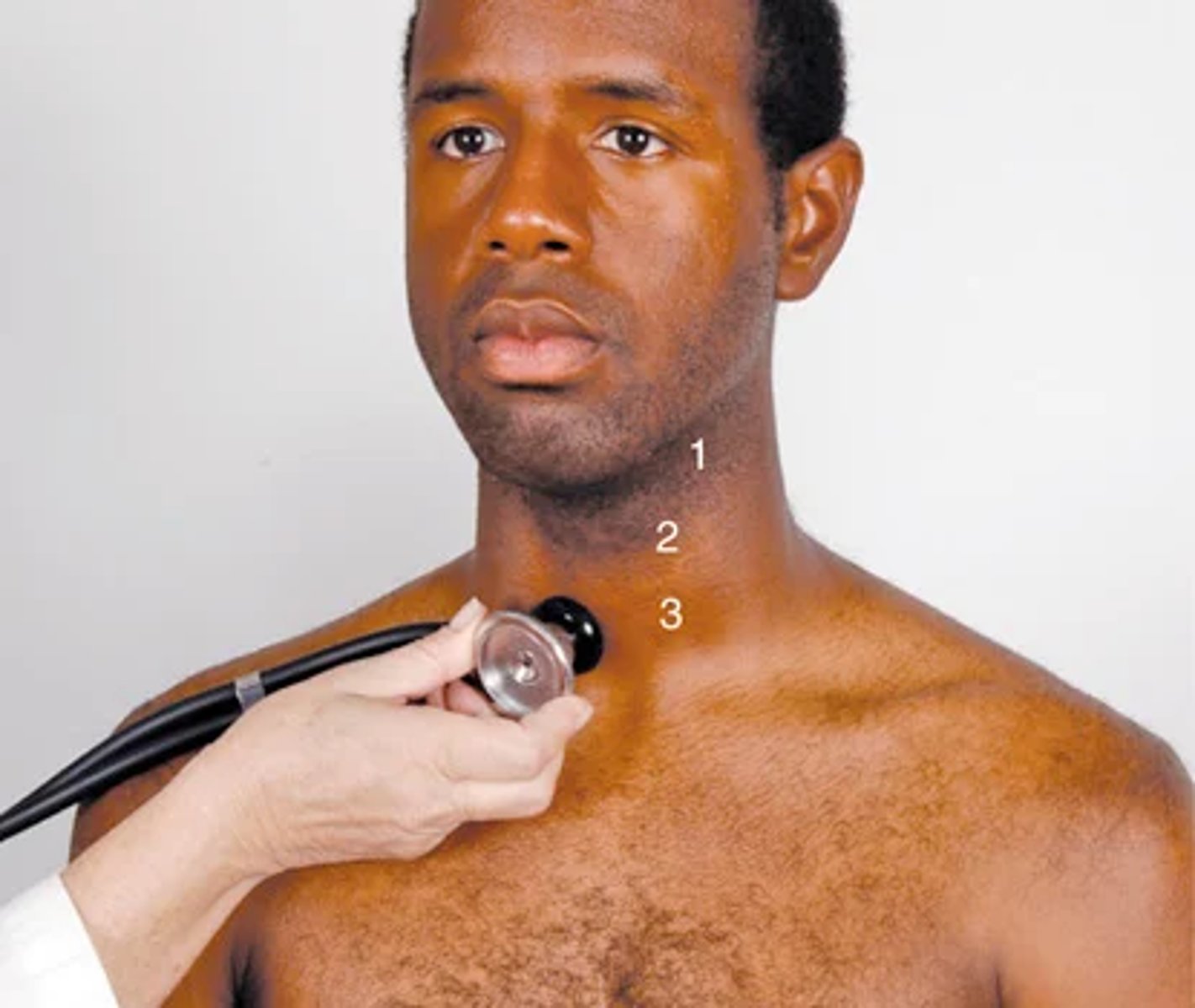 <p>older people who show signs of CVD -> auscultate each carotid artery for the presence of a bruit</p><p>(blowing swishing sound indicating blood flow turbulence)</p><p>Abnormal -> indicates turbulence from a local vascular cause and is a marker for atherosclerotic disease.; only moderately correlates with carotid artery stenosis</p><p>keep the neck in neutral position, lightly apply the bell over the carotid at 3 levels</p><p>(1) the angle of the jaw, (2) the midcervical area, and (3) the base of the neck</p><p>-Do not compress artery or you could create an artificial bruit or compromise circulation</p><p>-Ask the person to take a breath, exhale, and hold it briefly while you listen so tracheal breath sounds do not mask or mimic a carotid artery bruit</p><p>(can often hear normal heart sounds in the neck do not confuse with bruit)</p><p>ABNORMAL -> carotid bruit is audible when the lumen is occluded by 1⁄2 to 2⁄3; sound increases as atherosclerosis worsens until 2/3 occlusion</p><p>-After that, bruit loudness decreases. When the lumen is completely occluded, the bruit disappears</p><p>A murmur sounds much the same but is caused by a cardiac disorder.</p>