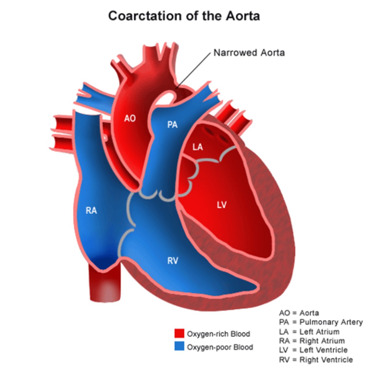 <p>Excessive sclerosing that normally closes the ductus arteriosus extends into the aortic wall leading to narrowing</p>
