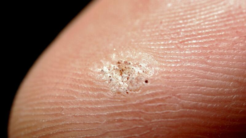 <p>AKA common wart caused by the HPV contagious and spread through direct contact or touching contaminated objects. MC areas are fingers, hands, arms </p>