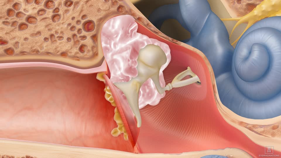 <p>Cholesteatoma</p>