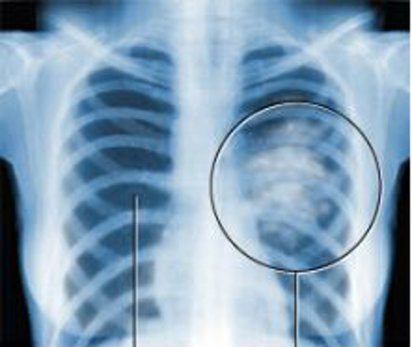 <p>A disease caused by uncontrolled cell growth that spreads through the body and destroys good cells.</p>