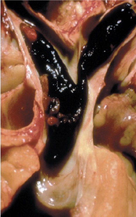 <p><span>1. Identify the shown lesion. <br>2. What is the serious complication of such a condition? <br>3. What is the most common origin of such a finding? extremities.&nbsp; <br></span></p>