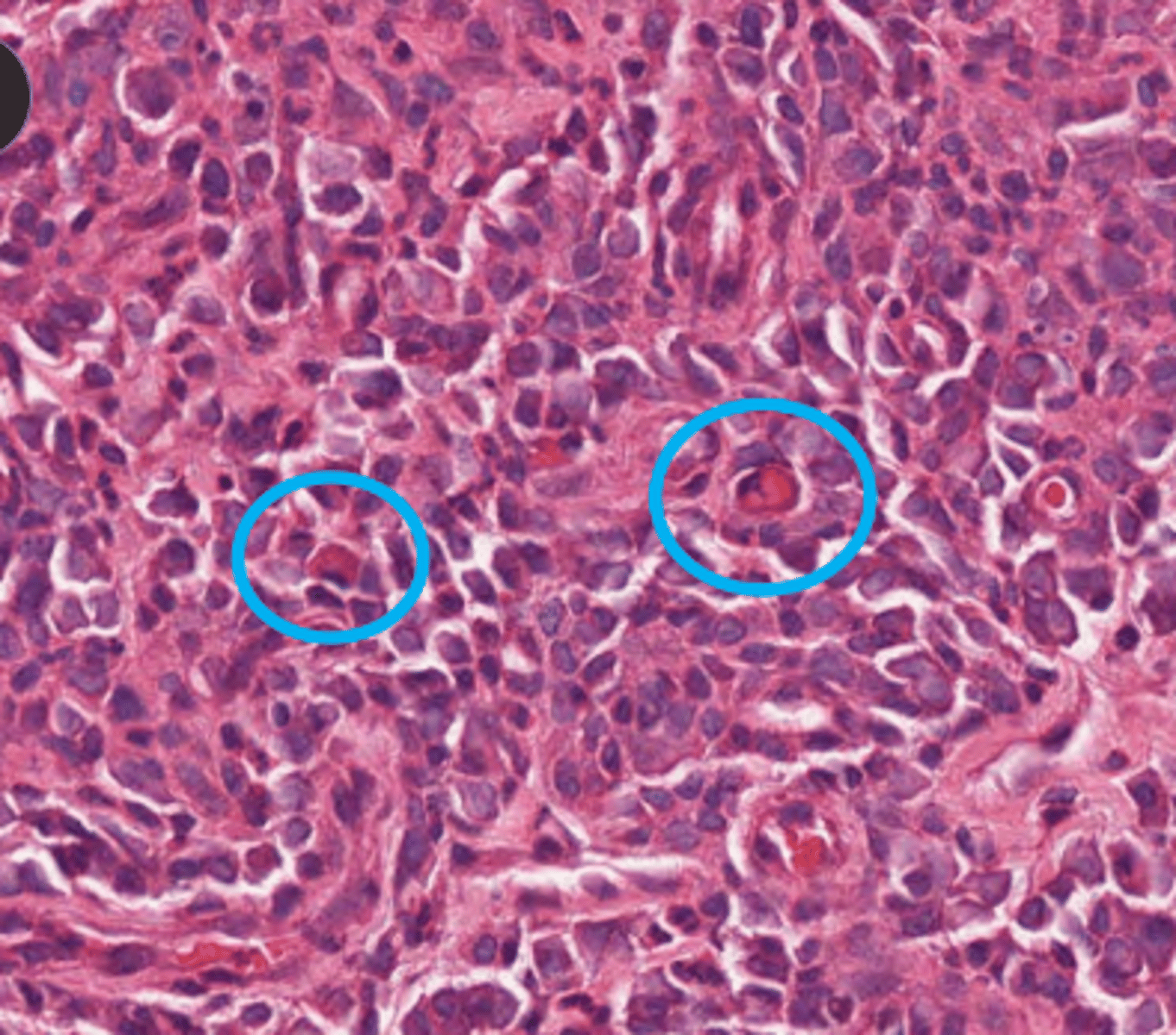 <p>true, russell bodies in plasma cells</p>