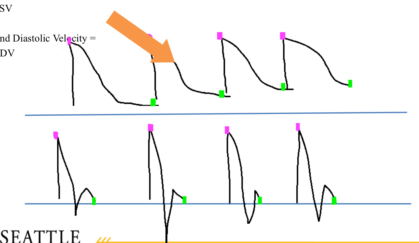 <p>Which one is showing peak systolic velocity (PSV) and which point is showing EDV </p>