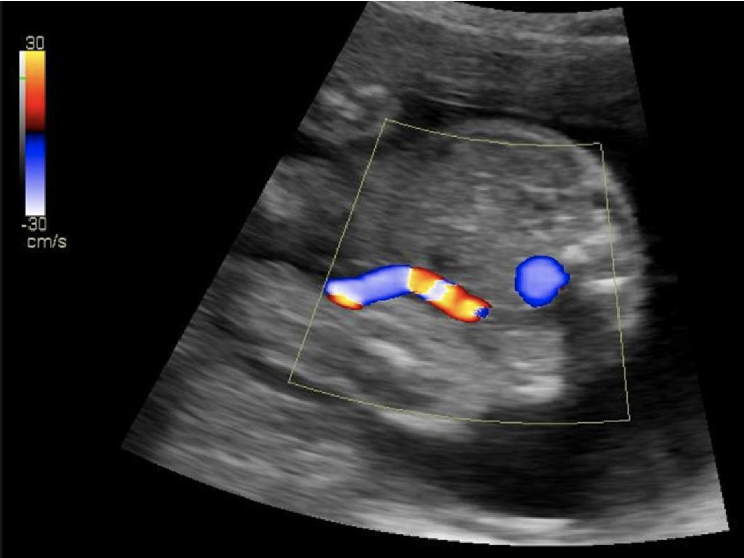 <p>what is the blue circle</p><p>a) IVC</p><p>b) umbilical artery</p><p>c) AO</p><p>d) umbilical varix</p>