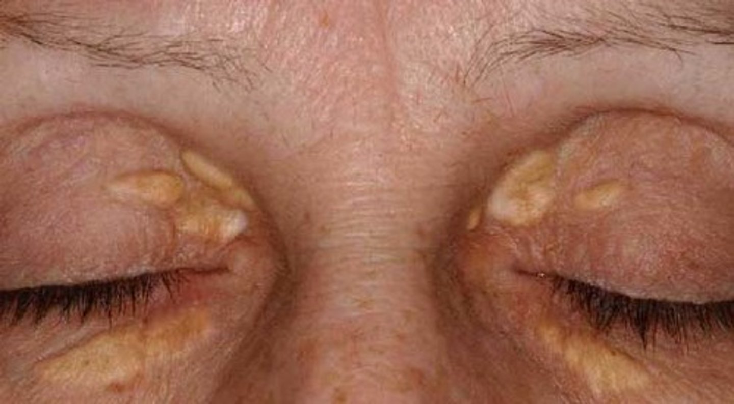 <p>= optstapeling van lipiden intracellulair ~ gelige letsels aan de mediale oogleden</p>