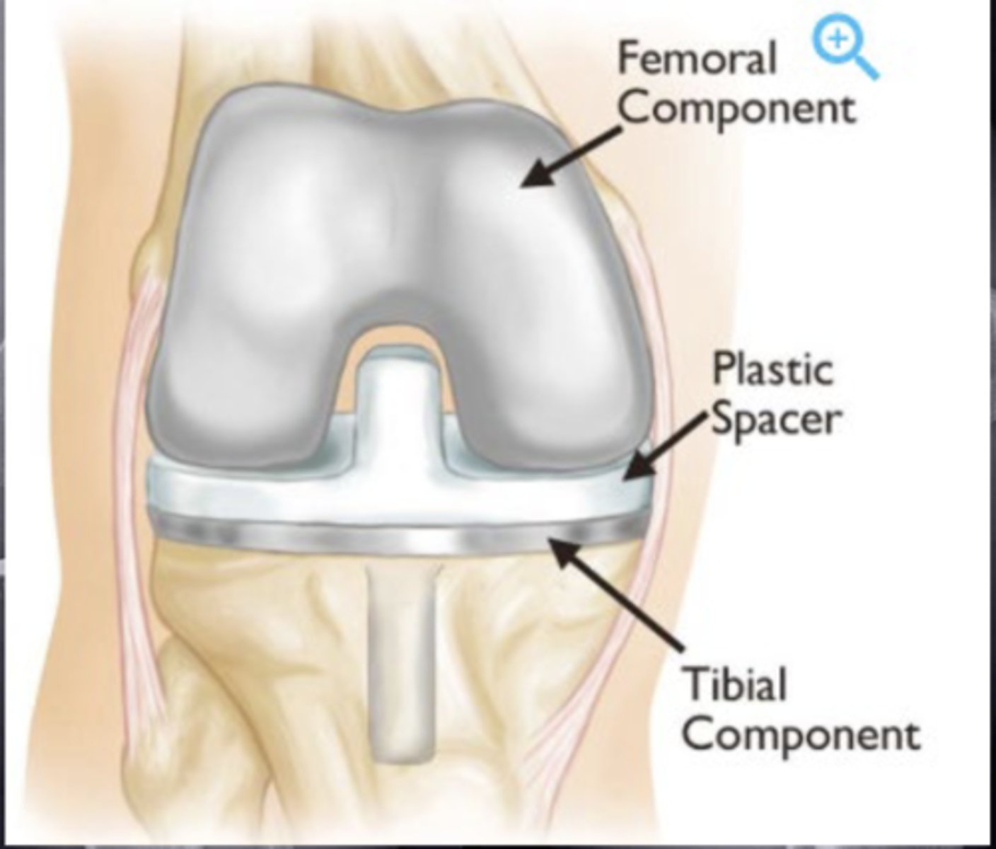 <p>tibial</p><p>femoral</p><p>patellar</p>