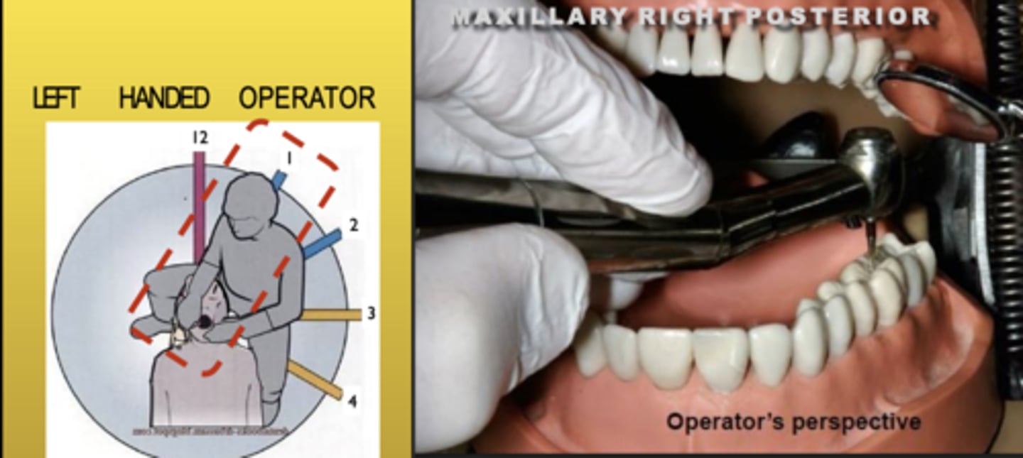 <p>Zone: 1</p><p>Vision: Indirect</p><p>Patient's Head: Center</p><p>Fulcrum: Max Left Premolars (O)</p>