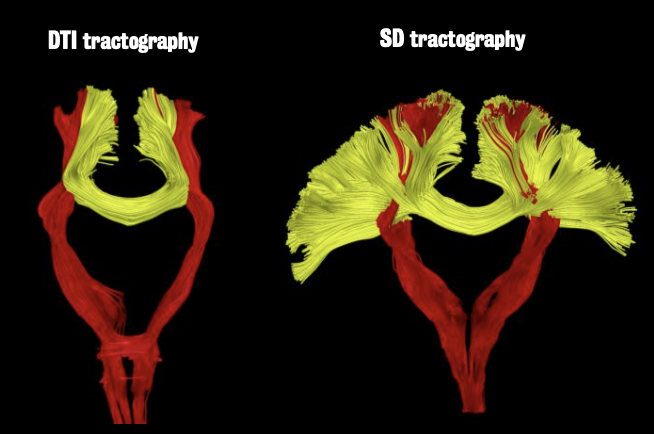 SD reconstructs the cingulum, eliminating crossing shown in cortical spinal tract
