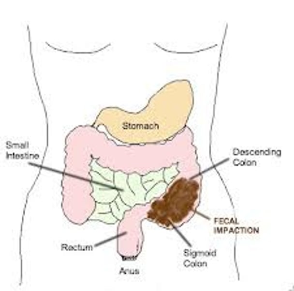 <p>prolonged retention or an accumulation of fecal material that forms a hardened mass in the rectum or colon that cannot be expelled by muscle contraction<br>- typically must be manually removed</p>