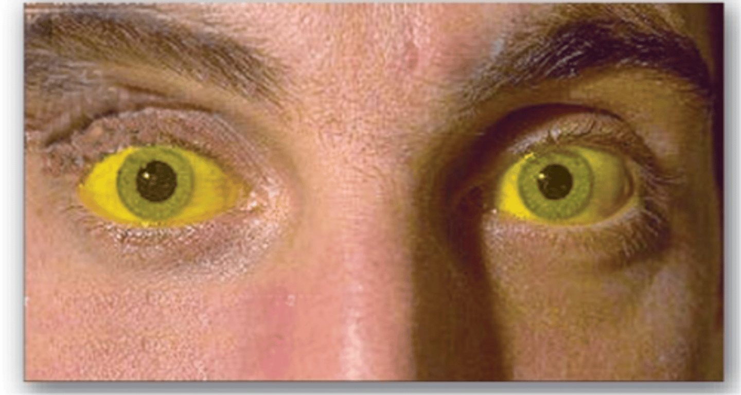 <p>2-17mM<br>Jaundice occours at 40 mM</p>