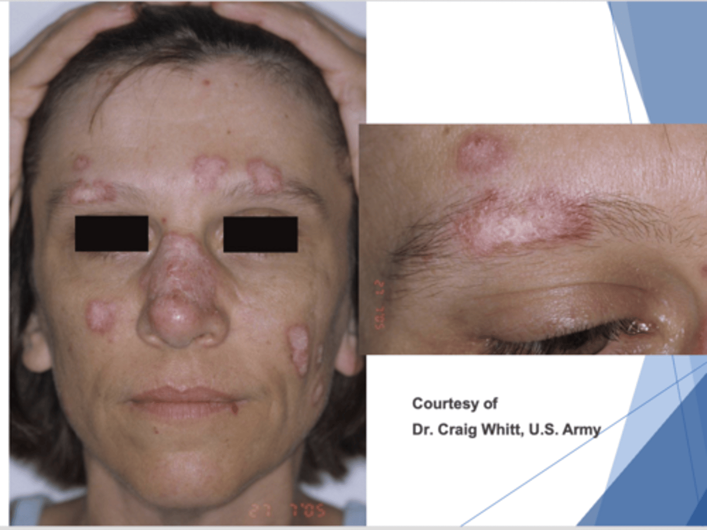 <p>These lesions are most likely caused by what condition?</p>