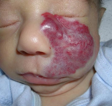 <p>most common tumor of infancy </p>