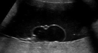 <p>Placental cysts</p>