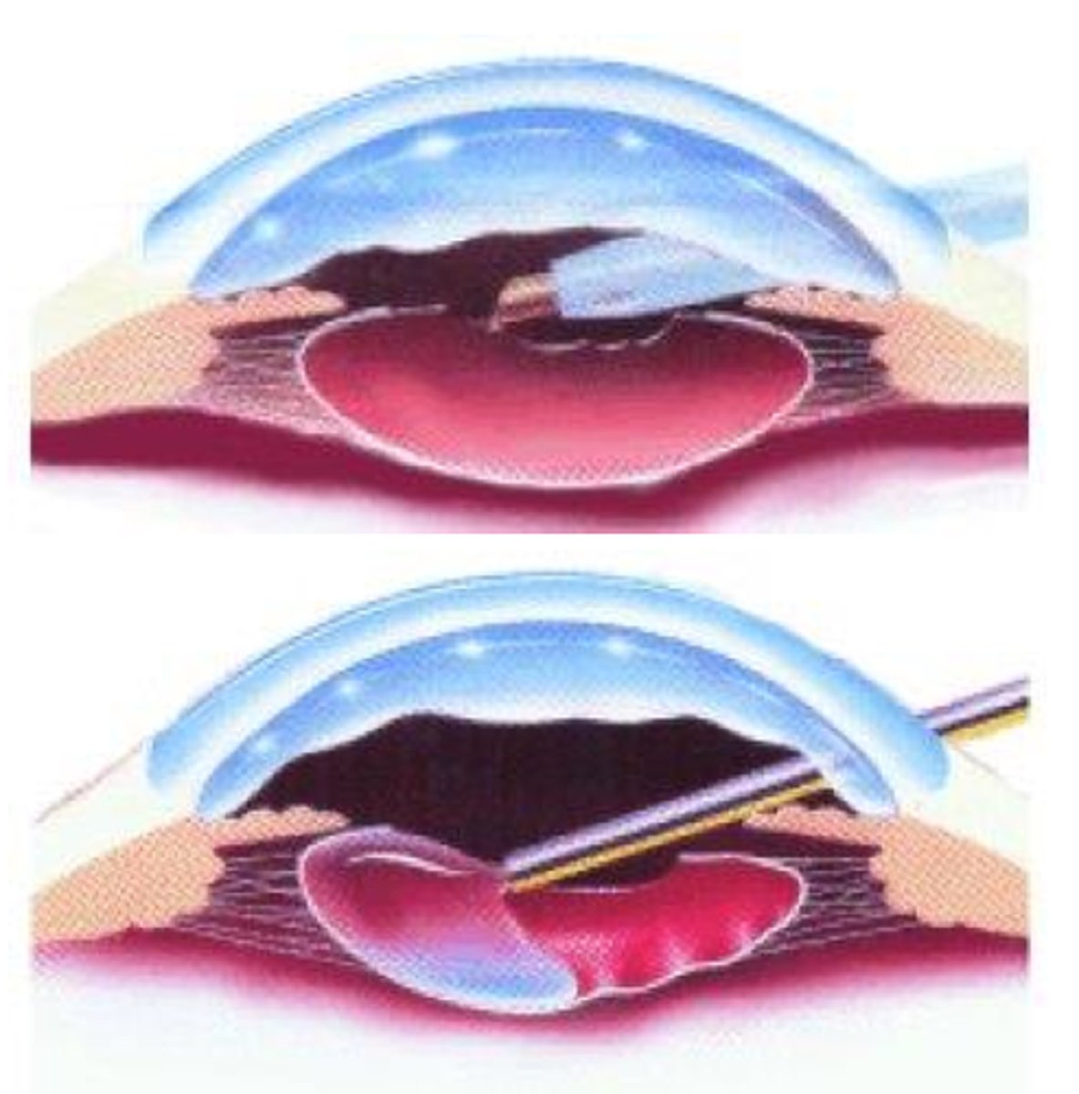<p>Extracapsular extraction</p>