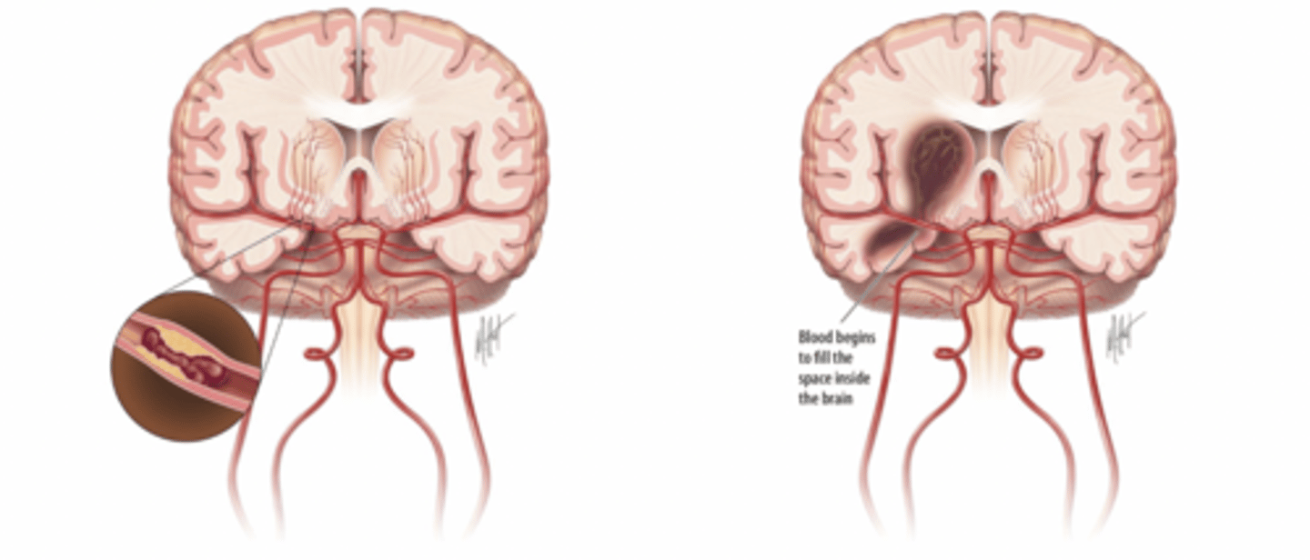 <p>-can be caused by sudden stroke (blockage or hemorrhage)</p><p>-blood supply to an area of the brain is blocked or reduced, causing tissue damage</p><p>-CVD can be progressive with high blood pressure and accumulation of fatty deposits in the arteries which block blood flow</p><p>-fatty deposiss and plaque buildup can cause arteries to become stiffer where they lose compliancy and elasticity</p>