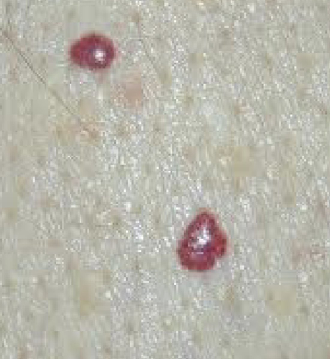 <p>A benign, tiny, vascular growth that occurs with aging</p>