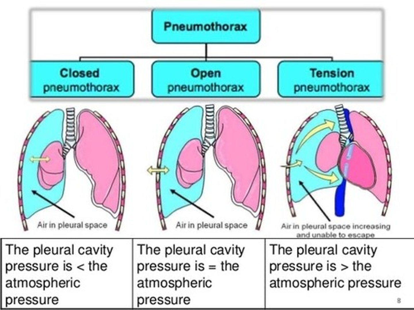 <p>- increased tension around the lungs with each breathe, pleural cavity pressure is greater than atmospheric pressure</p>