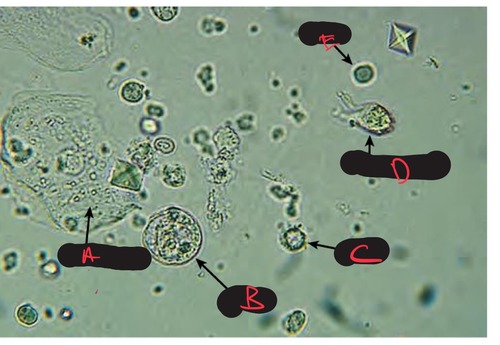 <ol><li><p>What type of cell is labeled ‘A’ when found in a person with STI?</p></li><li><p>What is the bacteria associated with cell labeled ‘A’?</p></li></ol><p></p>