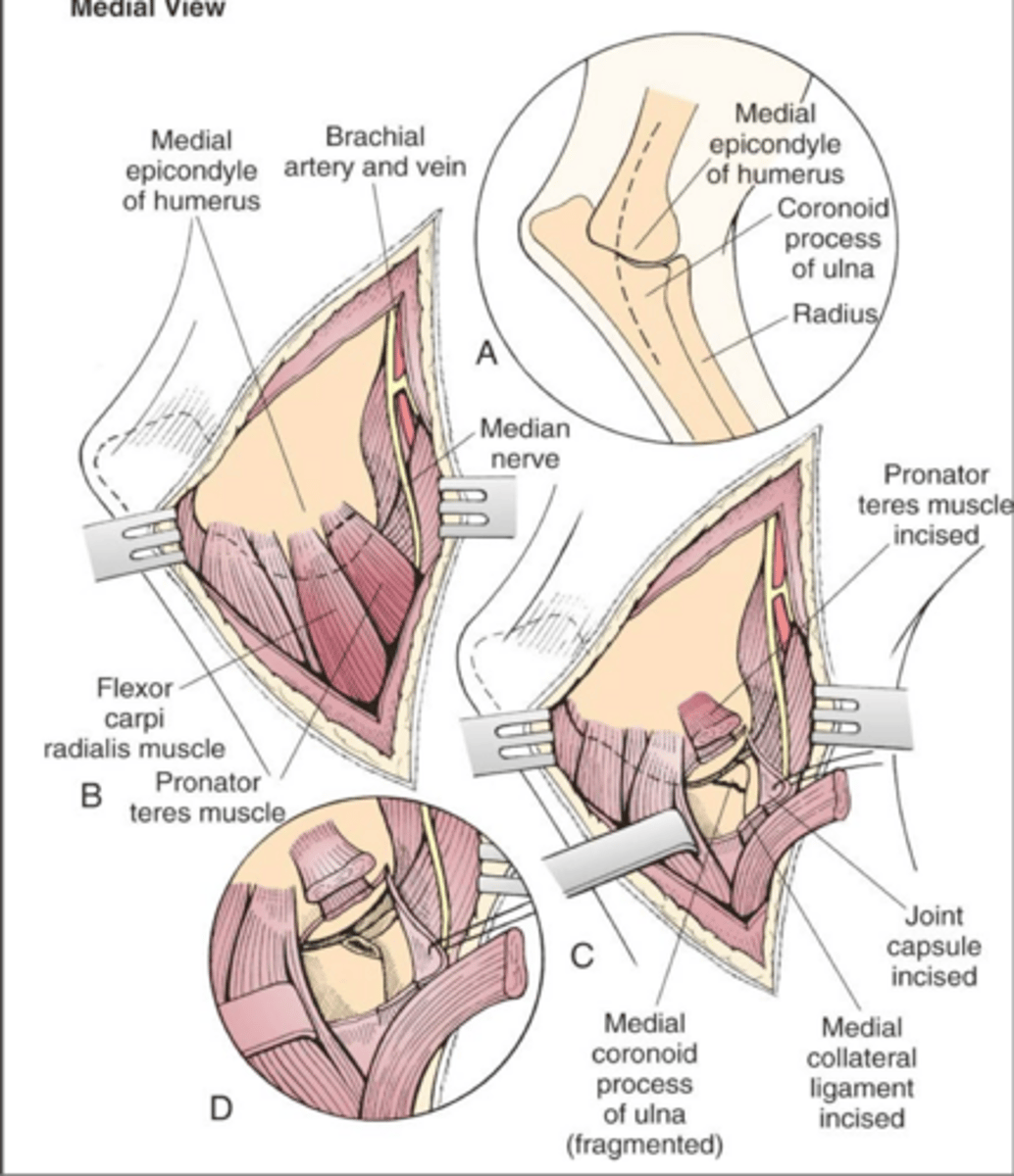 <p>what method of open FCP exposure is shown here</p>