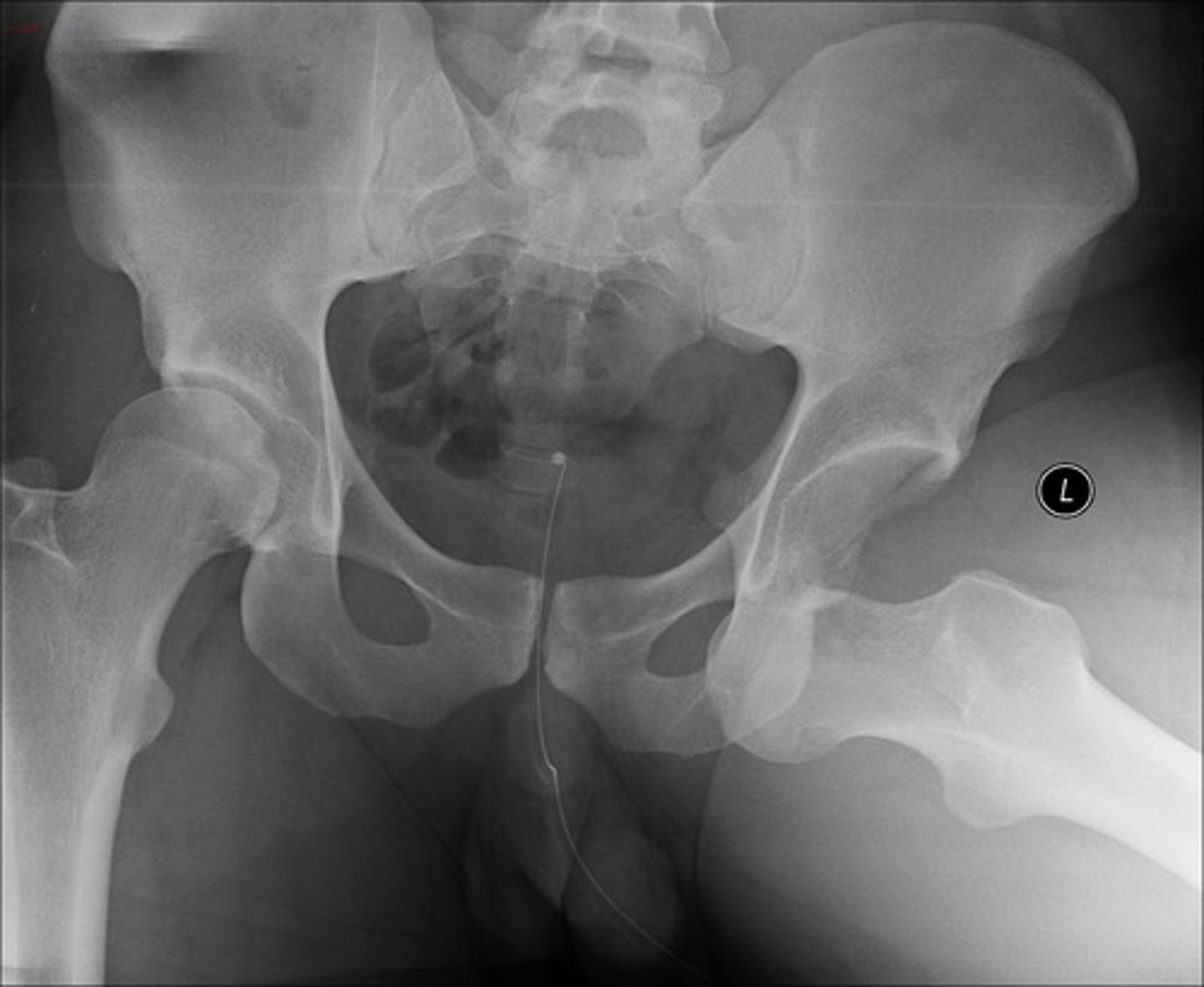 <p>- Uncommon</p><p>- Caused by major trauma or complication of total hip replacement surgery or hemiarthroplasty </p><p>1) Posterior dislocation (90% cases) = risk to sciatic nerve</p><p>2) Anterior dislocation </p>