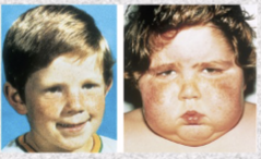 <p>excess of cortisol</p>