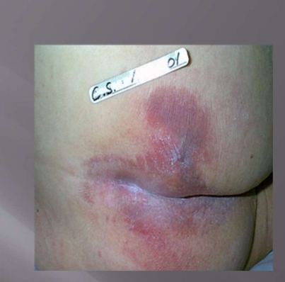 <p>Pressure Injury Stage 1</p>