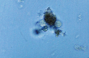 <p>Identify the urine sediment element shown:</p>