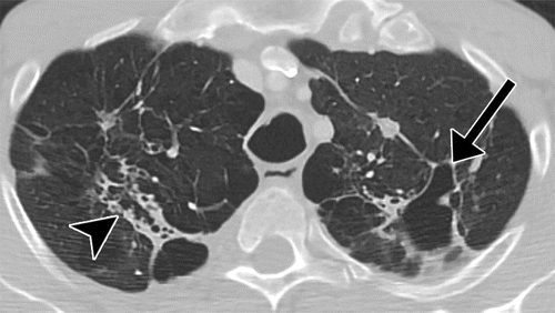 <p>Bacteria growing in the alveoli</p>