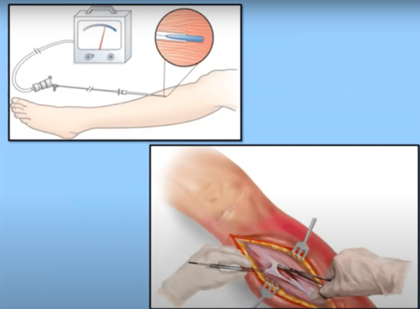 <p>Fasciotomy</p><p>-cut through the fascia to relieve pressure</p><p>-meters can be placed to record the pressure within a compartment</p><p>long recovery, may need skin grafts</p>