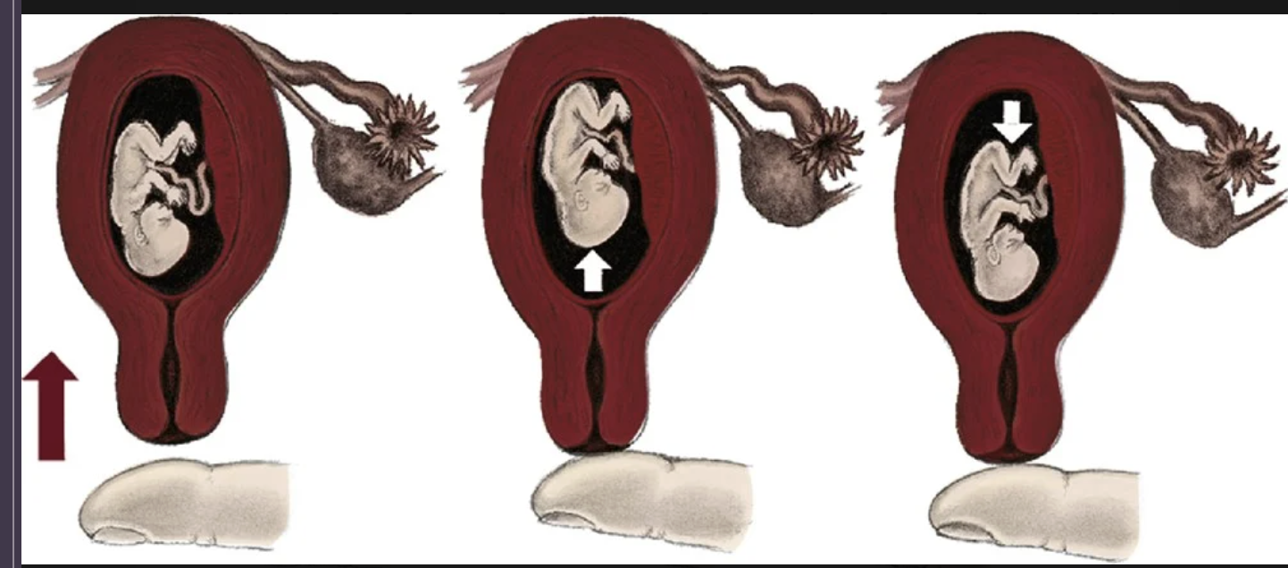 <p>16-18 weeks of gestatio. palpating a floating structure by bouncing it gently and feeling it rebound. examiner places a finger within the vagina and taps gently upward on the cervix causing the fetus to rise. The fetus then sinks, and a gentle tap is felt on the finger</p>