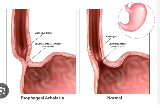 <p><span style="font-family: Droid Sans Mono, monospace">ACHALASIA</span></p>