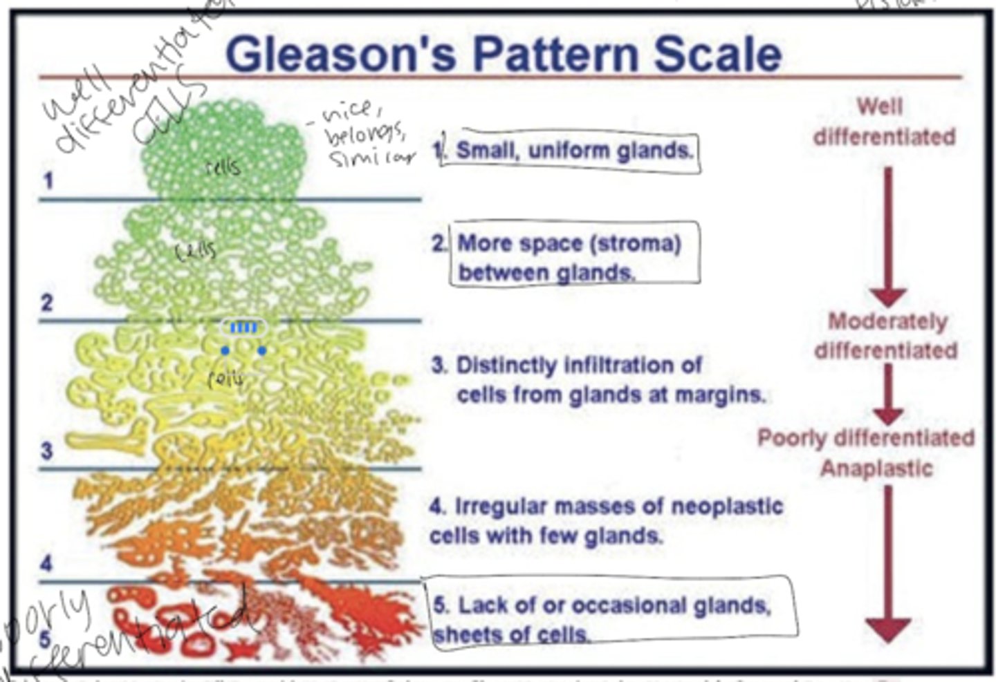 <p>measures how differentiated cancer cells are (how much tumor cells resemble normal cells)</p><p>- Well-differentiated (1-2): Cells look similar to normal tissue, grow slower, and are less aggressive.</p><p>- Moderately differentiated (3): Cells show some abnormality and faster growth.</p><p>- Poorly differentiated / Anaplastic (4-5): Cells lose structure and function, appear distorted, and grow uncontrollably — indicating high malignancy</p><p>More undifferentiated = more aggressive, invasive, and dangerous cancer.</p>