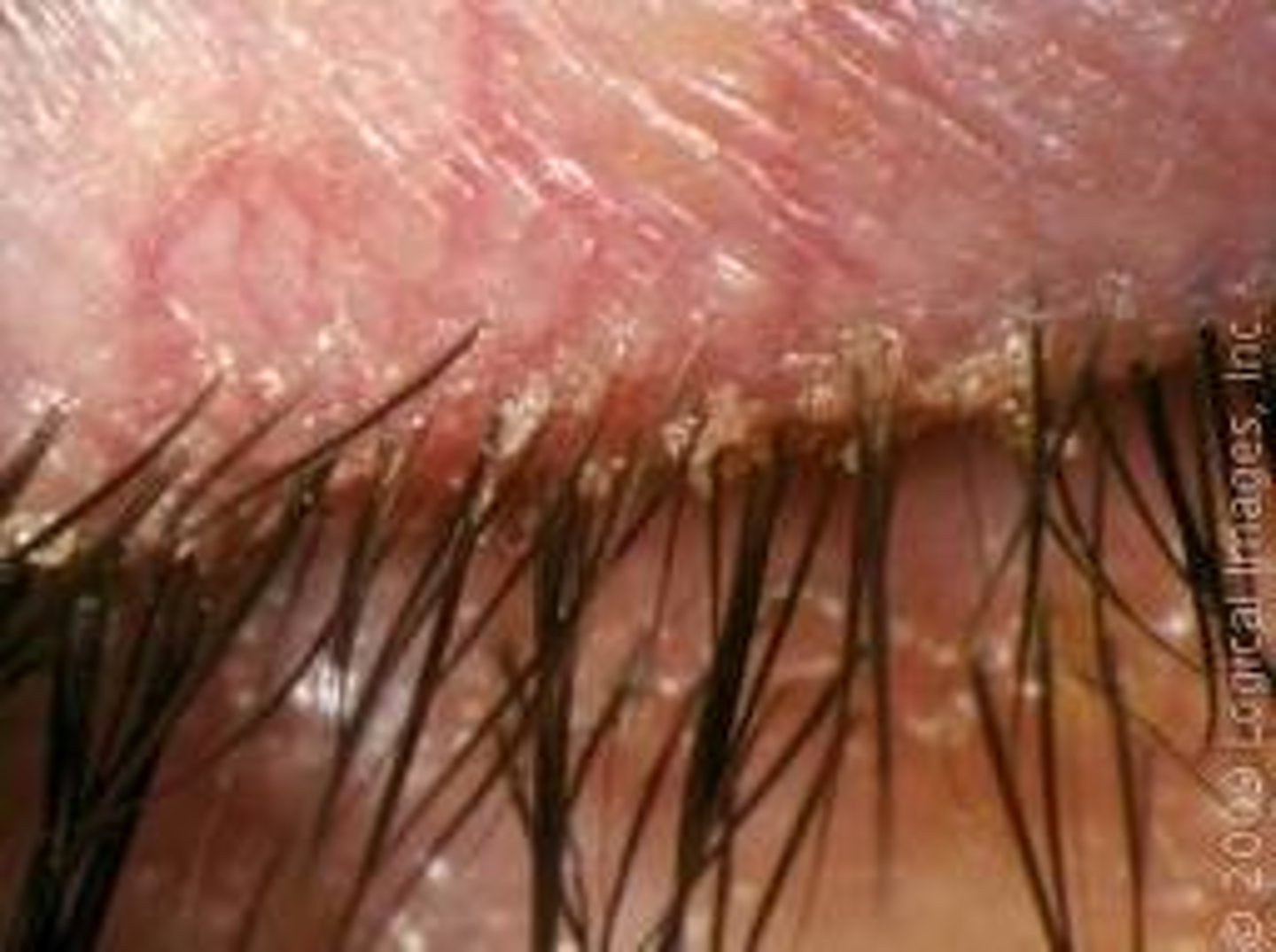 <p>Blepharitis; bacterial infection, seborrhea, or allergic response</p>