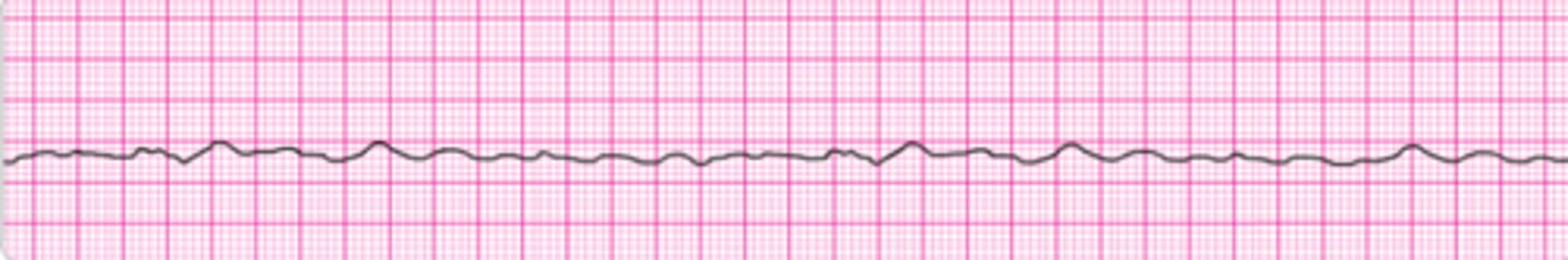 <p>Identify the rhythm.</p>