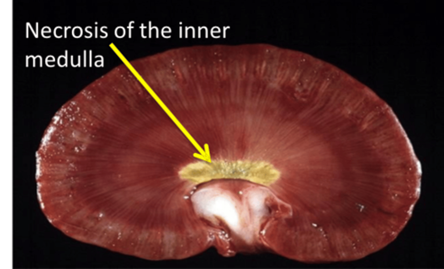 <p>Prolonged treatment or overdose of NSAIDs leading to reduced prostaglandin synthesis, reducing renal blood flow, causing ischemic necrosis</p>
