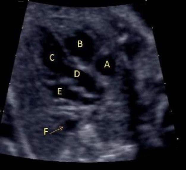 <p>what is letter D</p><p>a) right ventricle </p><p>b) right atrium</p><p>c) left ventricle</p><p>d) LVOT</p><p>e) RVOT</p>