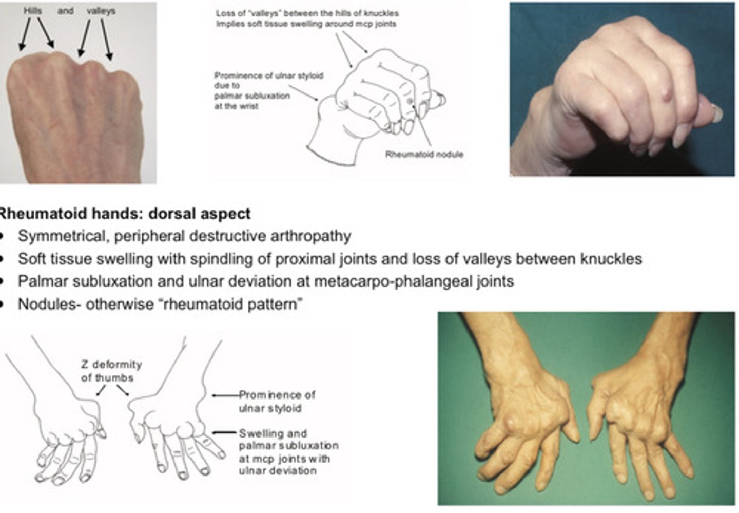 <p>Symmetrical, peripheral destructive arthropathy</p><p>Soft tissue swelling with spindling of proximal joints and loss of valleys between knuckles</p><p>Palmar subluxation and ulnar deviation at metacarpo-phalangeal joints</p><p>Nodules- otherwise "rheumatoid pattern"</p>