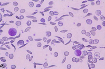 <ul><li><p>sickle cells</p></li><li><p>seen in deer &amp; angora goats</p></li></ul><p></p>