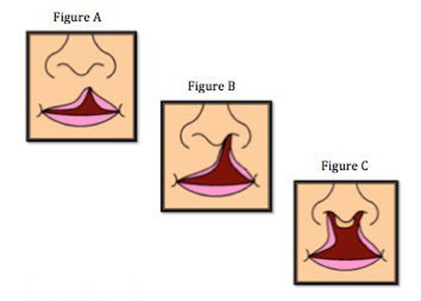 <p>Define Condition:</p><p>Abnormal gap at upper lip</p><p>-Hx: Present at birth</p><p>-Path: When these do not fuse at 5 weeks gestation</p><p>&gt; Median nasal processes merge --&gt; Intermaxillary process</p><p>&gt; Intermaxillary process merges w/ maxillary prominence &amp; lateral nasal process ==&gt; Upper Lip</p><p>-Sx/PE:</p><p>&gt; Unilateral or Bilateral Defect</p><p>&gt; May be complete (extends up to nostril) OR incomplete (extends only part way to nostril)</p><p>-Dx:</p><p>&gt; Routine Prenatal Ultrasounds (20 weeks)</p><p>&gt; Seen upon birth</p><p>-Tx: SURGERY</p><p>&gt; Cut tissue near cleft and rearrange to close opening, then realign</p><p>-Prog: Can feed and develop normally</p>