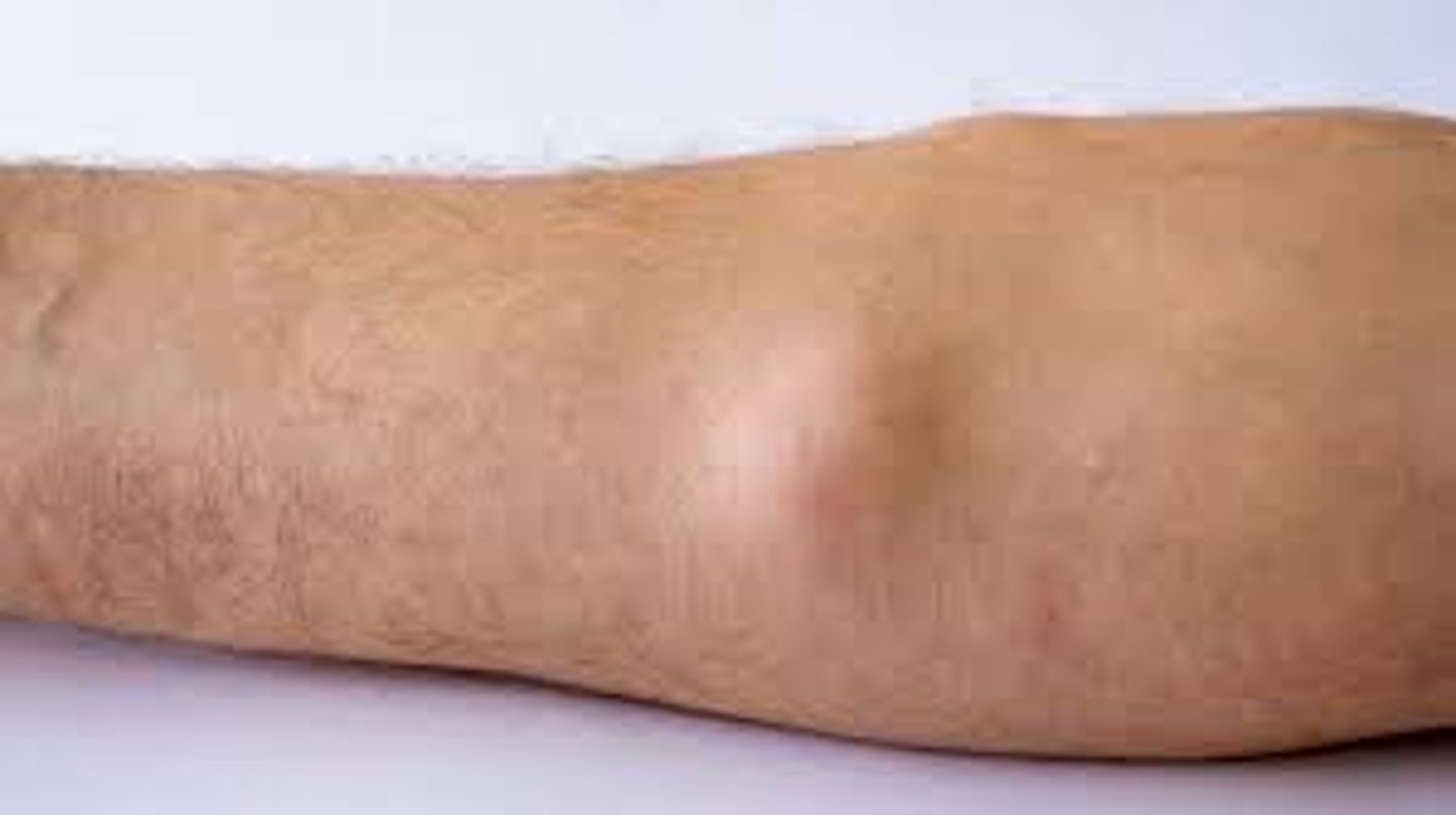 <p>Texture is the clue, feels like what it is, collection of fat under the skin</p><p>often solitary</p><p>can occasionally be tender</p>