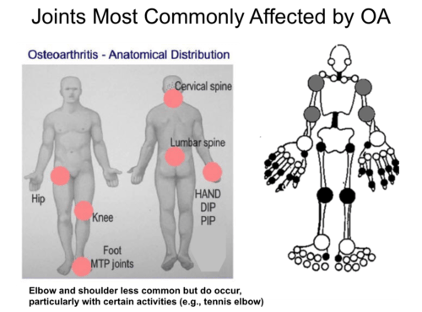 <p>-hand: DIP, PIP, thumb CMC</p><p>-cervical and lumbar spine</p><p>-feet: MTP</p><p>-knees, hips</p>
