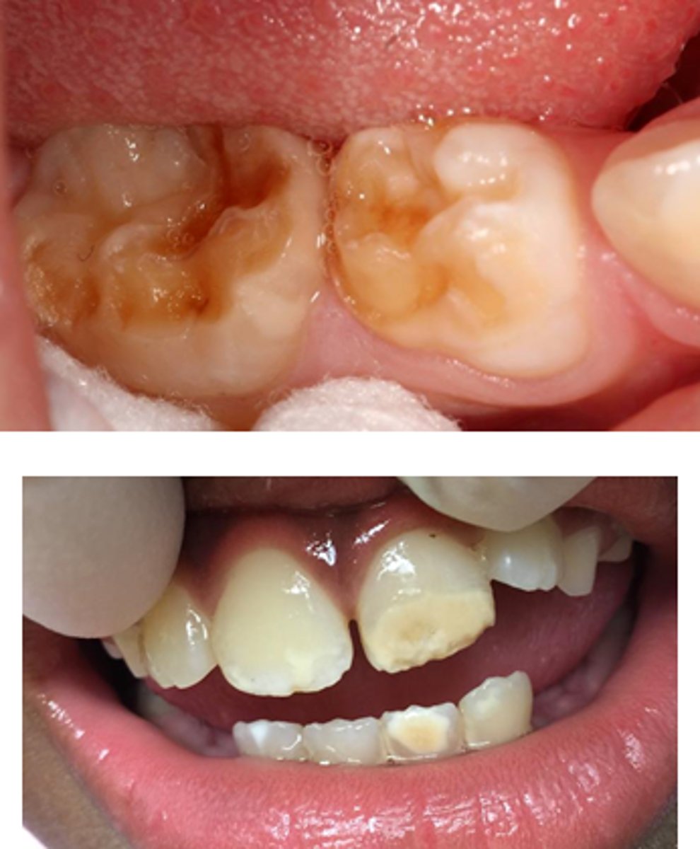 <p><b>High protein content</b><br>- Subject to enamel breakdown soon after eruption -&gt; caries</p>