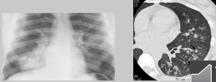 <p>inflammation produces <strong>small patches of consolidation</strong> throughout the lungs — <strong>no air bronchograms</strong> present</p>