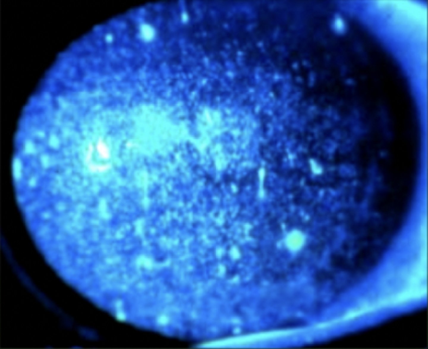 <p><u>Etio</u>: burns to the cornea, <strong>unaware of UV exposure until 6-12 hrs later</strong></p><p><u>Risk factors</u>: sunlamps, welding, skiing, "snow blindness", looking into solar eclipse</p><p><u>S&amp;S:</u> severe pain, severe photophobia</p><p><u>Testing:</u> fluorescein: diffuse punctate staining to both cornea</p><p><u>Tx</u>: emergent consult ophthalmologist, both eyes may have to be patched for 24-48 hrs </p>