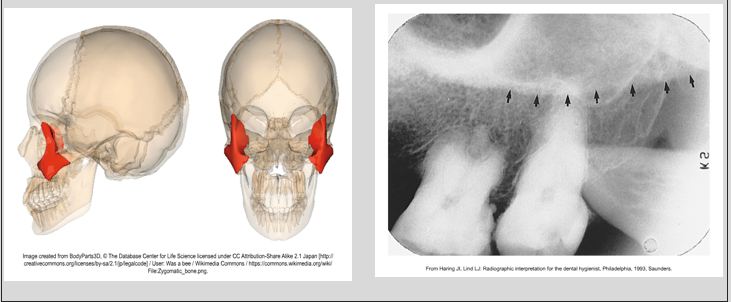 <p><span>·</span><span style="font-family: "Times New Roman"; line-height: normal; font-size: 7pt;"><span> </span></span><span>Articulates with the zygomatic process of maxilla</span></p><p class="MsoListParagraphCxSpLast"><span>·</span><span style="font-family: "Times New Roman"; line-height: normal; font-size: 7pt;"><span> </span></span><span>A diffuse, radiopaque band extending posteriorly from the zygomatic process of the maxilla</span></p><ul><li><p class="MsoListParagraphCxSpLast">seen on the maxillary molar and premolar periapicals</p></li></ul><p></p>