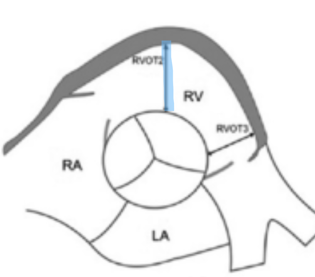 <p>Using PLAX or PSAX AO measure RVOT</p>