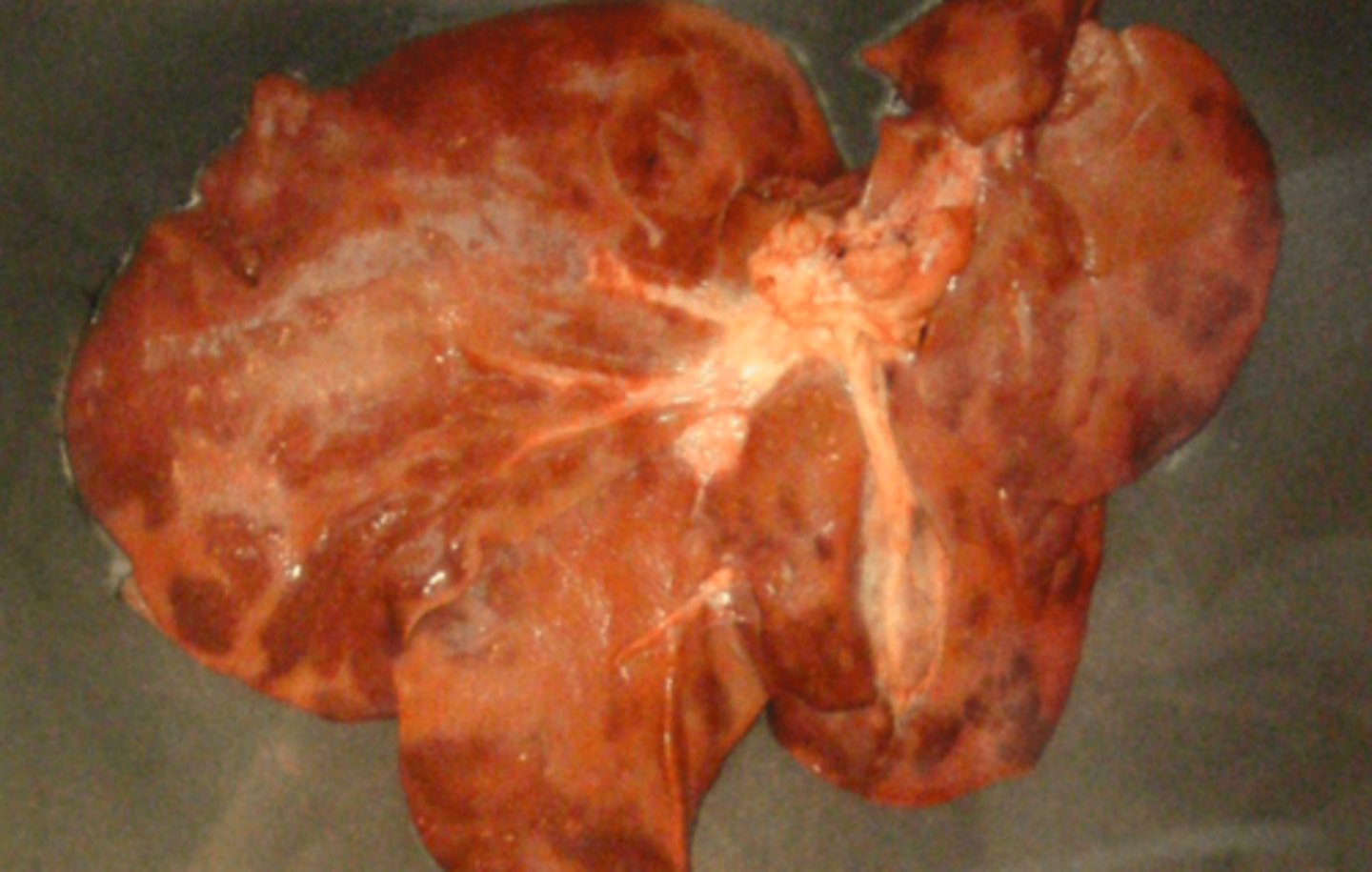 <p>Lever fra svin, hvad er den patoanatomiske diagnose?</p>