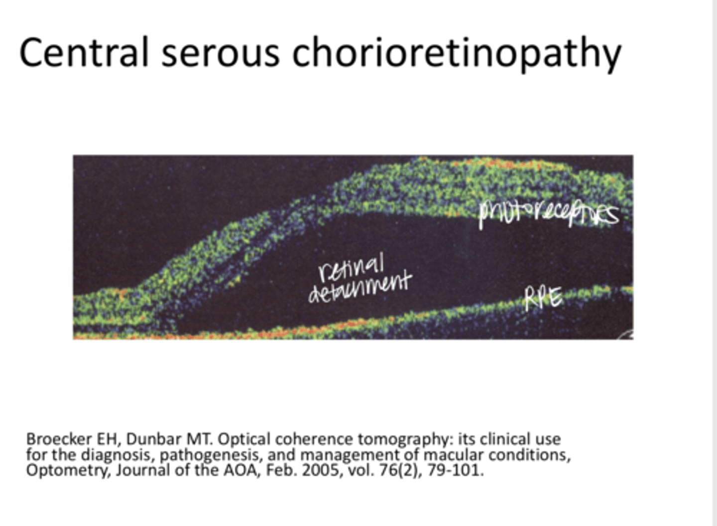 <p>Central Serous Retinopathy -- Macular OCT (Pic)</p>