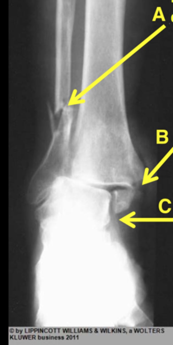 <p>typically seen with torsional force on the ankle</p><p>- twisting of the talus leads it malleolar fractures and dislocation of the talus away from subtalar joint</p>